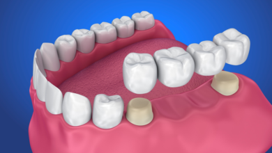 removable dental bridges