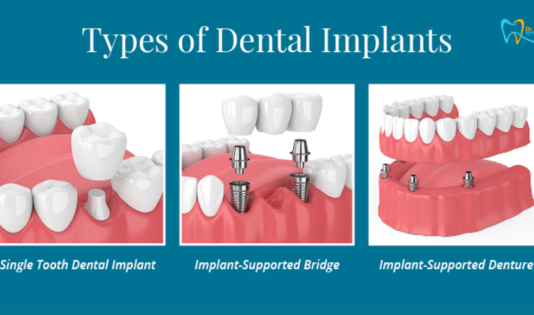 dental implants - kukreja